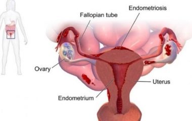 Endometriozis (Çikolata Kisti)